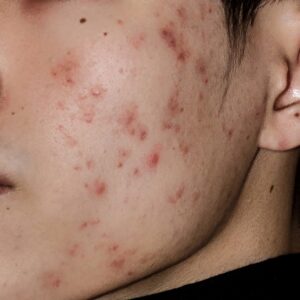 Hormonal Acne is a sign of hormonal imbalance in the skin